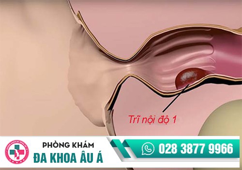 Hình ảnh trĩ nội