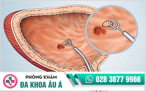 Cẩn thận với hiện tượng tiểu ra mủ để tránh nguy cơ vô sinh