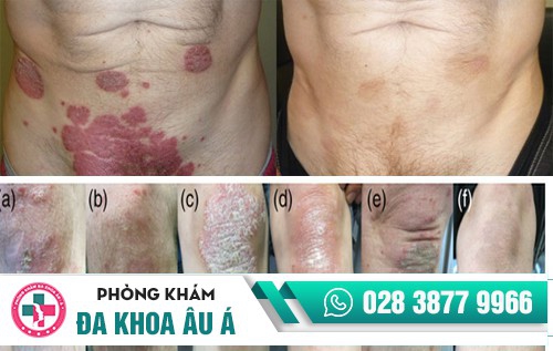 Các bệnh da liễu được điều trị tại Phòng Khám Da Liễu Âu Á