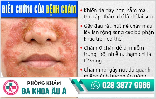 Bệnh chàm có lây không? Bị chàm nguy hiểm không?