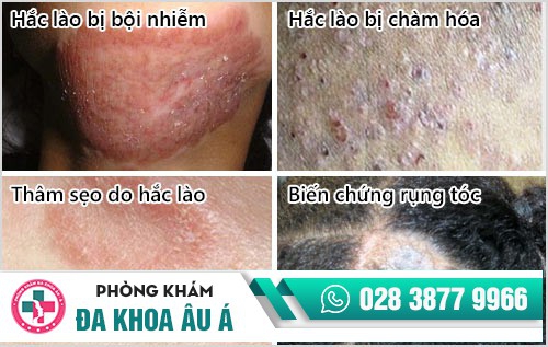 dấu hiệu bệnh hắc lào