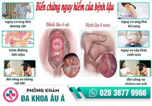 Ngứa âm đạo do bệnh lậu