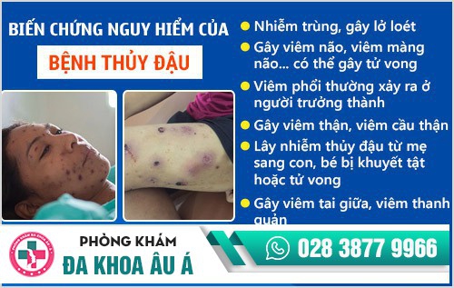 biến chứng của bệnh thủy đậu