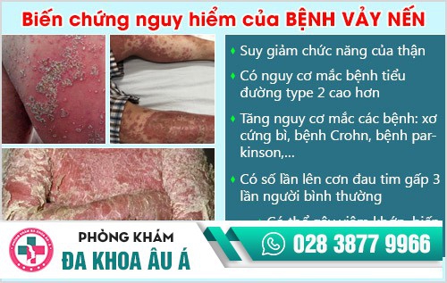 Bệnh vảy nến và những thông tin cần biết