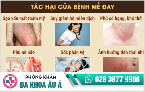 Cách trị nổi mề đay an toàn, hiệu quả