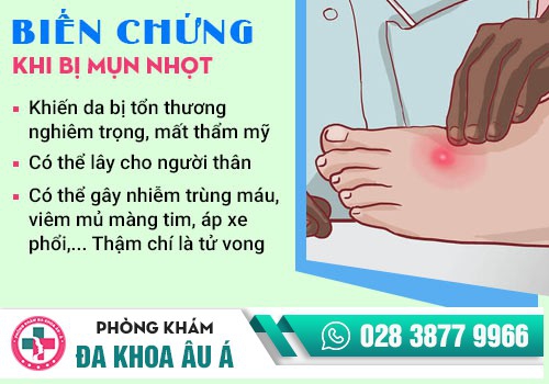 Các phương pháp chữa mụn nhọt an toàn, hiệu quả