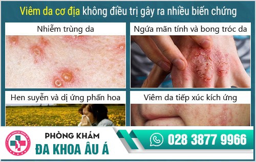 viêm da cơ địa