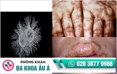 biểu hiện bệnh lậu ở nam giới