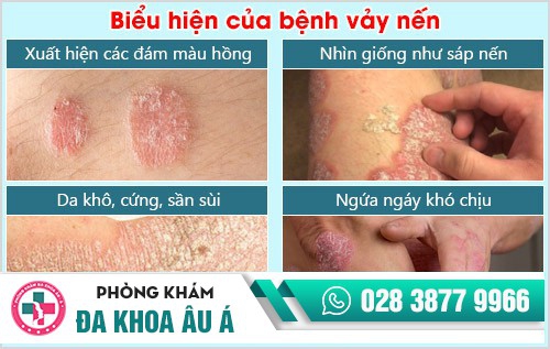 Bệnh vảy nến và những thông tin cần biết