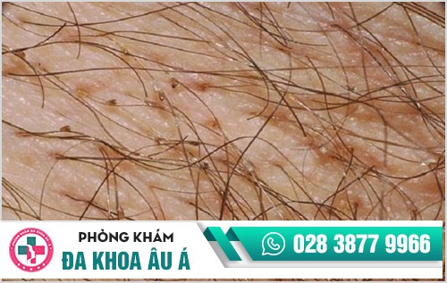 Những điều cần biết về bệnh rận mu