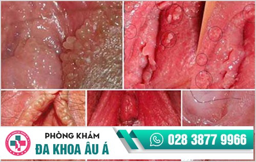 Bệnh sùi mào gà, căn bệnh dễ lây nhiễm nhưng khó điều trị