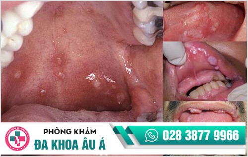 biểu hiện sùi mào gà