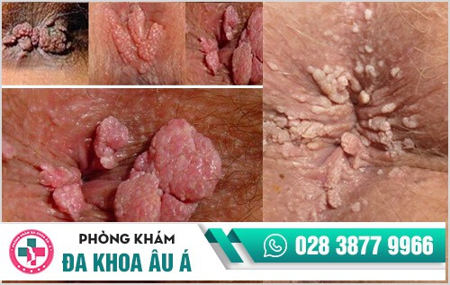 biểu hiện sùi mào gà