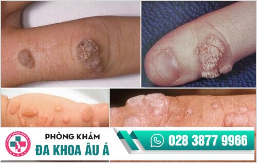 biểu hiện sùi mào gà