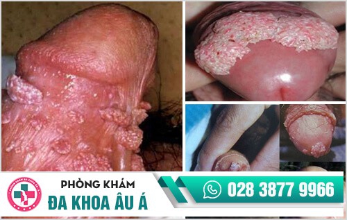 biểu hiện sùi mào gà