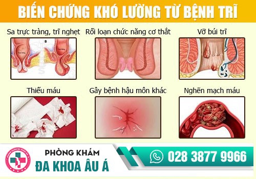 Những biến chứng mà bệnh trĩ gây ra