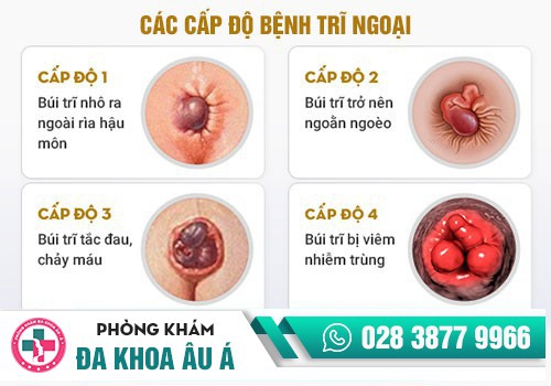 cấp độ bệnh trĩ ngoại