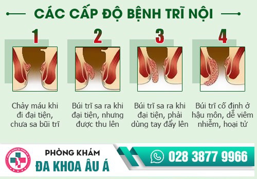 Hình ảnh bệnh trĩ các cấp độ 