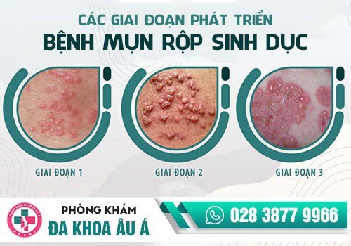 Mụn rộp sinh dục
