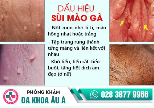 bao quy đầu nổi hạt