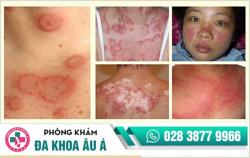 lupus ban đỏ