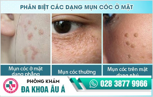 Mụn cóc ở mặt: Dấu hiệu và cách điều trị