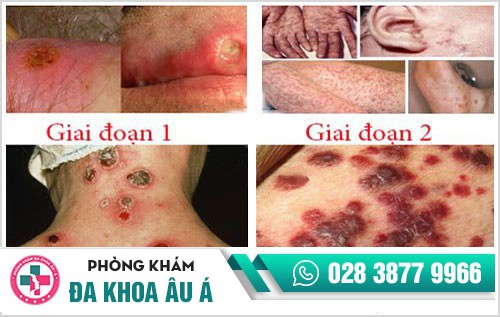 Nhận biết nhanh các biểu hiện bệnh giang mai