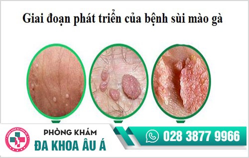 Các giai đoạn sùi mào gà và biểu hiện cụ thể