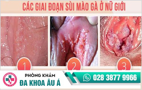 Các giai đoạn sùi mào gà và biểu hiện cụ thể