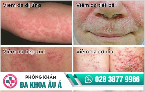 cách trị viêm da