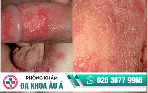 Cách chữa mụn vùng kín và địa chỉ chữa trị uy tín bạn nên biết