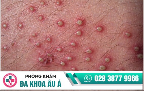 Cách chữa mụn vùng kín 