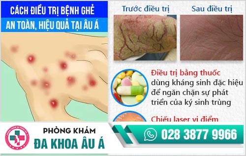 cách trị bệnh ghẻ
