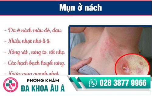 Cách trị mụn ở nách hiệu quả và không đau