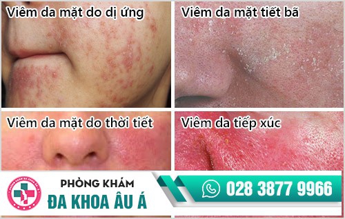 điều trị viêm da mặt