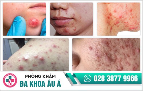 Khám mụn nhọt ở đâu tốt nhất tại TP.HCM?