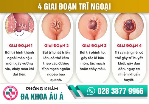 DẤU HIỆU BỆNH TRĨ VÀ CÁCH PHÂN BIỆT CÁC LOẠI BỆNH TRĨ