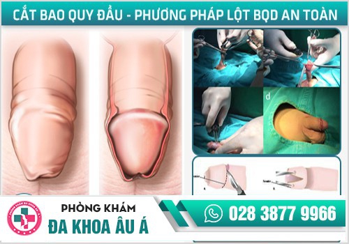 Phương pháp cắt bao quy đầu hiện đại