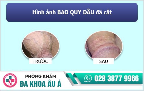 BAO QUY ĐẦU DÀI CÓ NÊN CẮT?