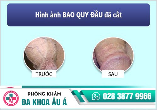 Hình ảnh cắt bao quy đầu xong