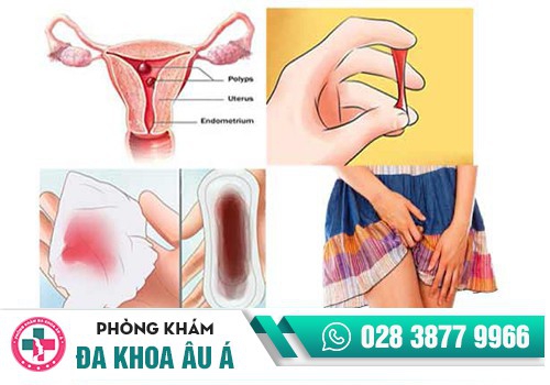 Chảy máu âm đạo bất thường là dấu hiệu gì?