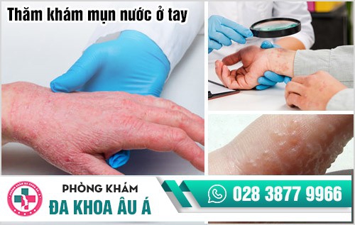 mụn nước ở tay