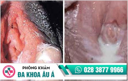 chữa bệnh lậu tại nhà chữa bệnh lậu tại nhà