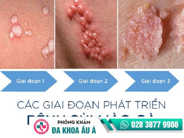 Sùi mào gà - Bệnh dễ lây nhiễm nhưng khó điều trị