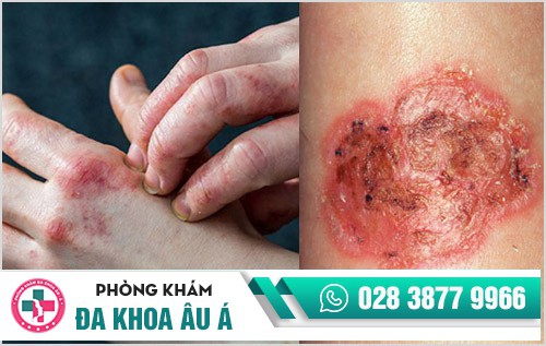 Hình ảnh bệnh ghẻ ngứa