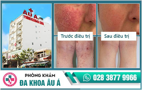 phương pháp điều trị viêm da
