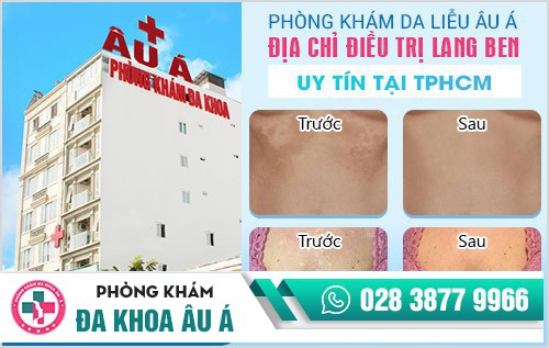 Địa chỉ điều trị lang ben tốt nhất tại TP.HCM