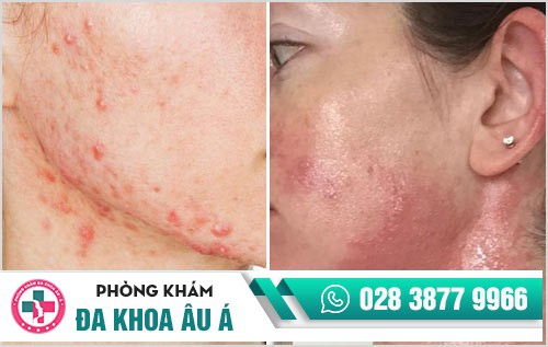 da mặt bị mẩn đỏ