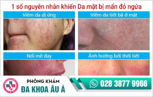 da mặt bị mẩn đỏ