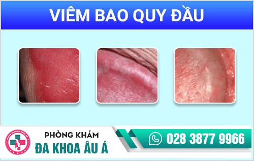 Đau buốt quy đầu do viêm nhiễm